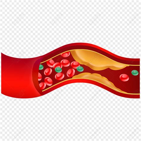 Vascular Blockage Human Blood Vessel Illustration Cerebral Vessels ...