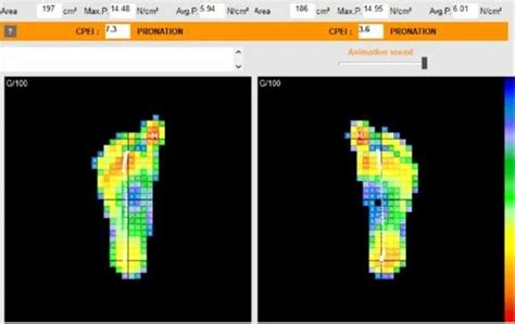 Plantar Pressure Equipments - Plantar Pressure Foot Imprinter Harris ...