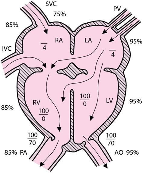 Image:Atrioventricular septal defect (complete form)-MSD Manual ...