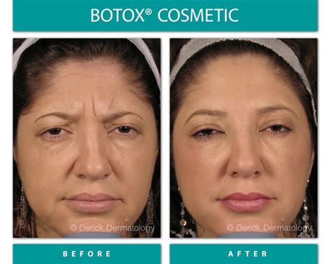 What Botox Looks Like After Years of Use, According to Derms