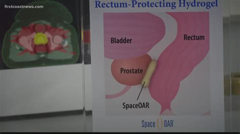 Gel minimizes side-effects from prostate cancer radiation | firstcoastnews.com