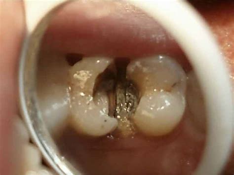 怎么判断是牙髓炎还是牙龈炎？牙髓炎的早期三大症状必看 - 口腔资讯 - 牙齿矫正网