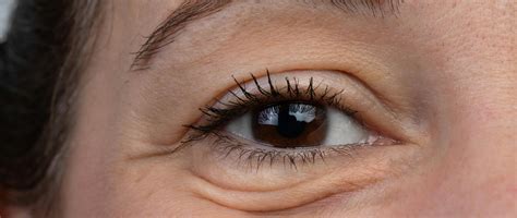 Eye Puffiness: Triggers & Prevention Tips | Fluent Health