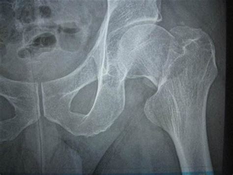 X光片解读股骨头坏死各类分期方法 | 骨科在线