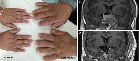 Acromegaly Before And After Early Descriptions Of Acromegaly And