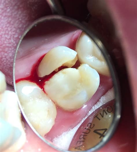 Cracked tooth of the day | Dr. Gentry