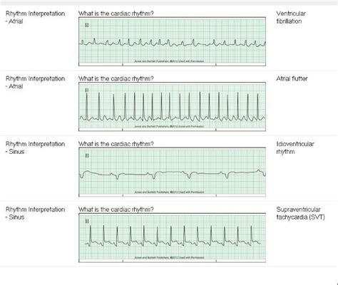 Basic ECG Rhythms 的图像结果