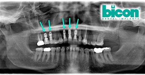 Bicon MaxIntegra-CP Implant dentaire | SpotImplant