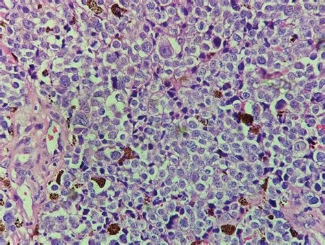 Primary Rectal Malignant Melanoma: Case Report of a Rare Entity