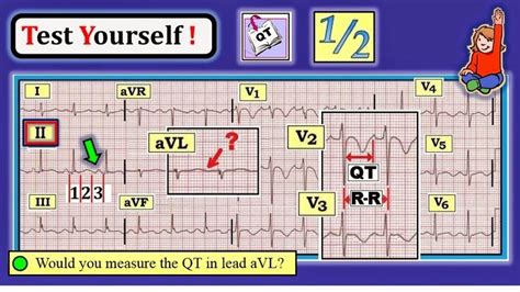Image result for Normal ECG Interval Values