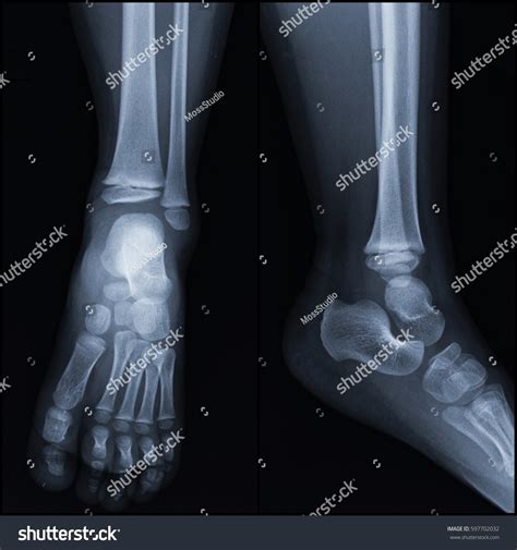 Normal Ankle Xray Ap