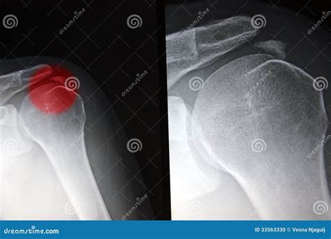 Painfull Shoulder, Calcific Tendonitis, Tendinitis Stock Photo - Image of bursitis, orthopedic ...