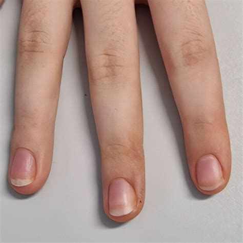 Was lange dauerte, wird endlich gut - Dermatologie - Universimed ...