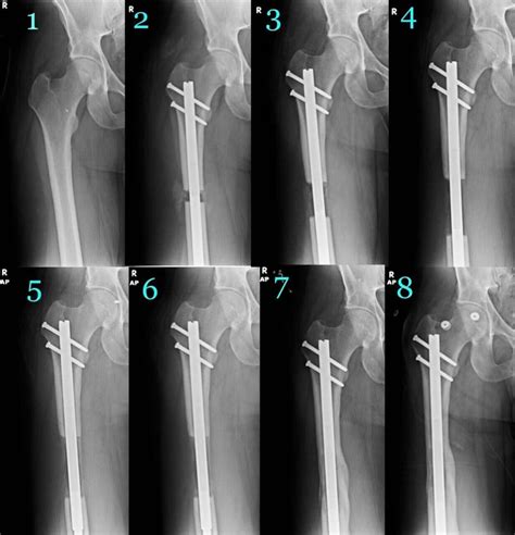 Surgeon Kevin Debiparshad Performs Leg-Lengthening Surgery | LimbplastX Institute