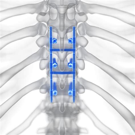 Pros And Cons Of Spinal Fusion Surgery | New Jersey | Comprehensive ...