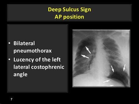 Image result for Step and Sulcus Sign