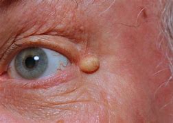 Image result for Cysts under Skin