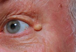Image result for Epidermoid