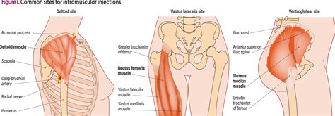 Image result for Injection Sites