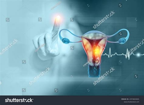 Female Reproductive System Diseases Uterus Cancer Stock Illustration 2371815021 | Shutterstock
