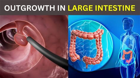 Image result for Colonoscopy Polypectomy