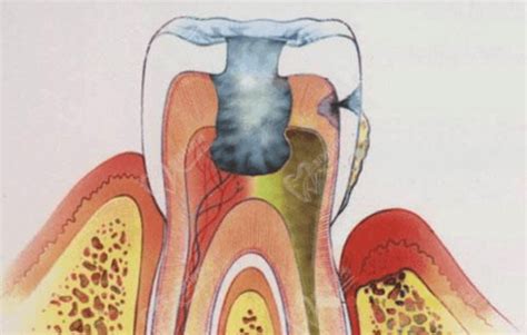 牙髓炎感染了怎么治疗-爱康健齿科