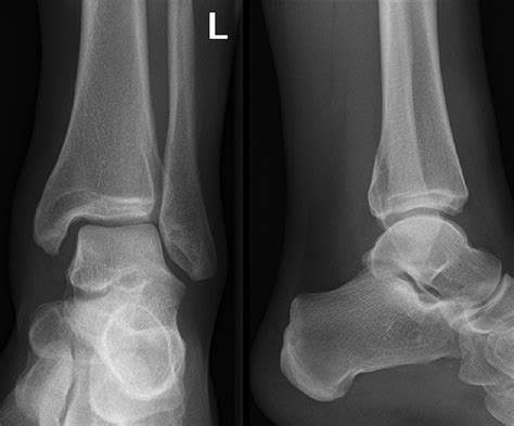 Mortise and Lateral View X-ray of Left Ankle. Mortise and lateral view ...