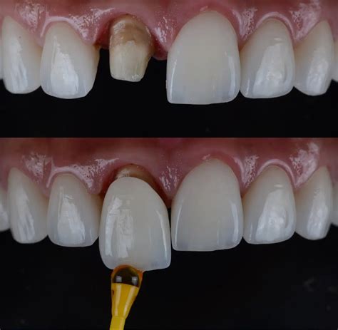 Anterior Crowns: The Ultimate Guide For Dentists | Avant Dental