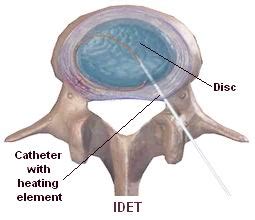 Image result for Idet Disc Procedure