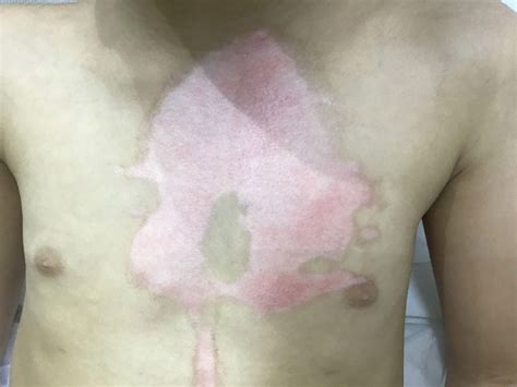 Revolutionising paediatric burn scar management: Unleashing the potential of stromal vascular ...