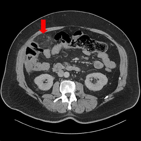 Image result for CT Scan with Contrast