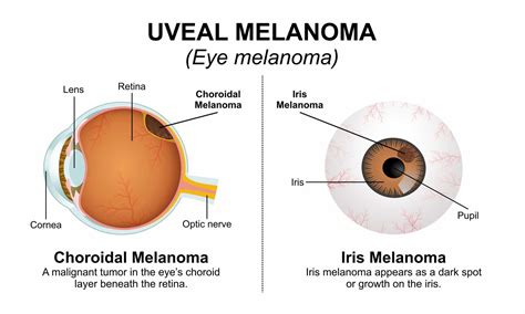 Uveal Melanoma - Creative Diagnostics