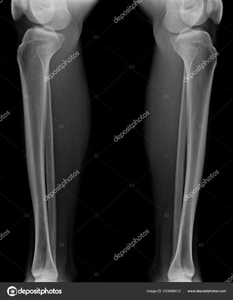 Ray Image Hight Quality Tibia Fibular Bone — Stock Photo © Tridsanu #233088412