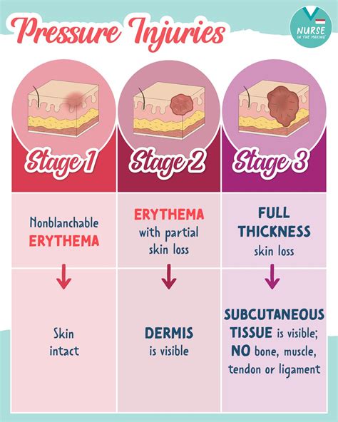 Kristine Tuttle | Pressure Injuries🩸💦 🛏️A pressure injury is the ...