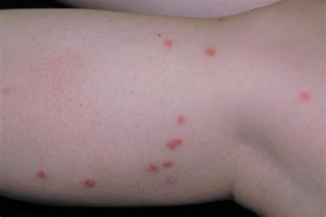 Picaduras De Insectos Infectadas Que Hacer – EHTN