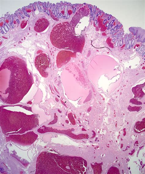 Thrombosed Hemorrhoid Timeline at Lea Warren blog