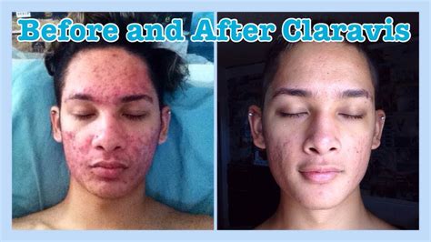 Image result for Claravis Compounding Powder