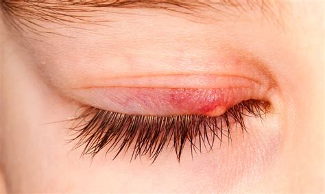 ¿Por qué salen los orzuelos? ¡Conoce sus causas!