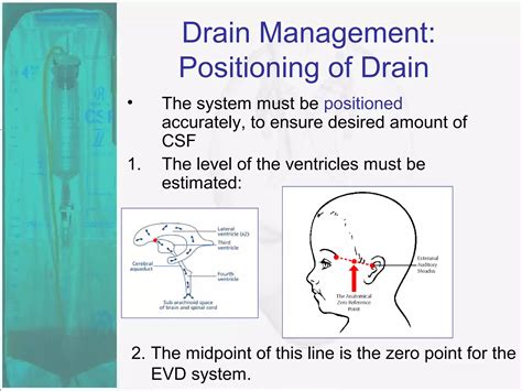 External Ventricular Drain | PPT