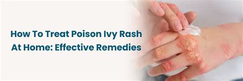 Effective Home Remedies for Poison Ivy Rash