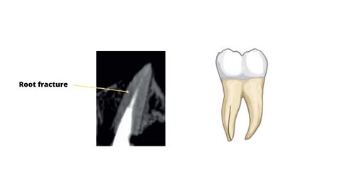 The telltale signs of failed root canal with X-ray pictures