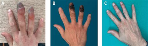 Therapie von Erfrierungen - Plastische Chirurgie - Universimed ...