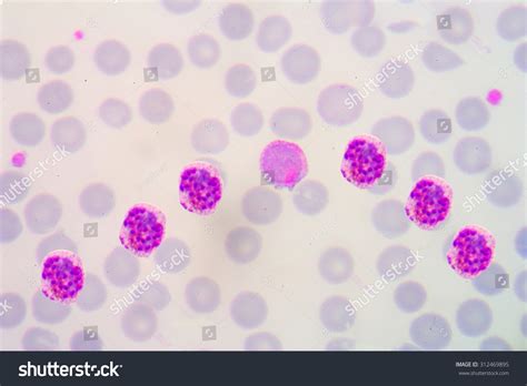 Malaria Blood Smear Pictures Stock Photo 312469895 | Shutterstock