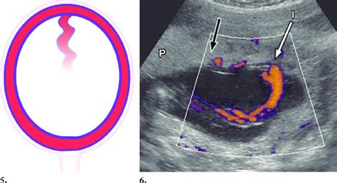 Bildergebnis für velamentous umbilical cord ultrasound