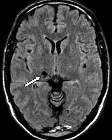 Virchow-Robin Spaces at MR ImagingRadioGraphics