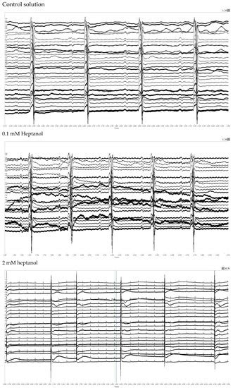 Heterogeneities in Ventricular Conduction Following Treatment with ...