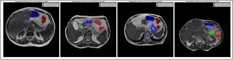 Image result for Medical Image Segmentation MATLAB