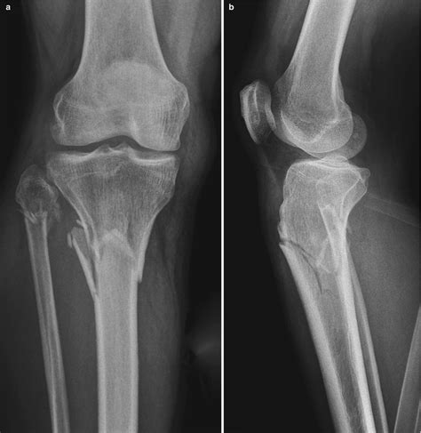 Proximal Tibia 的图像结果