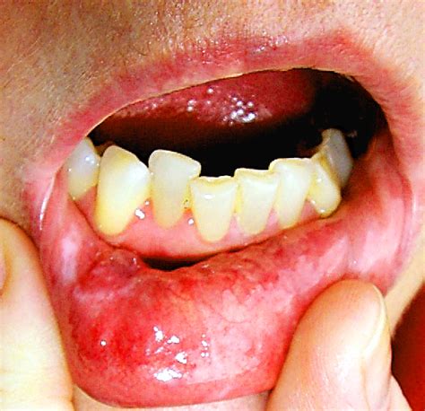 Kuvatulokset haulle blister on inner lip of mouth