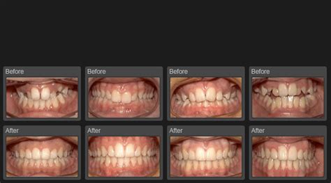 Orthodontia Braces Treatment Ahmedabad Gujarat India,Crooked ...